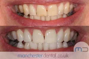 Teeth-Whitening-with-URL_0001_Whitening work gallery (4) Teeth-Whitening-with-URL_0001_Whitening work gallery (4)
