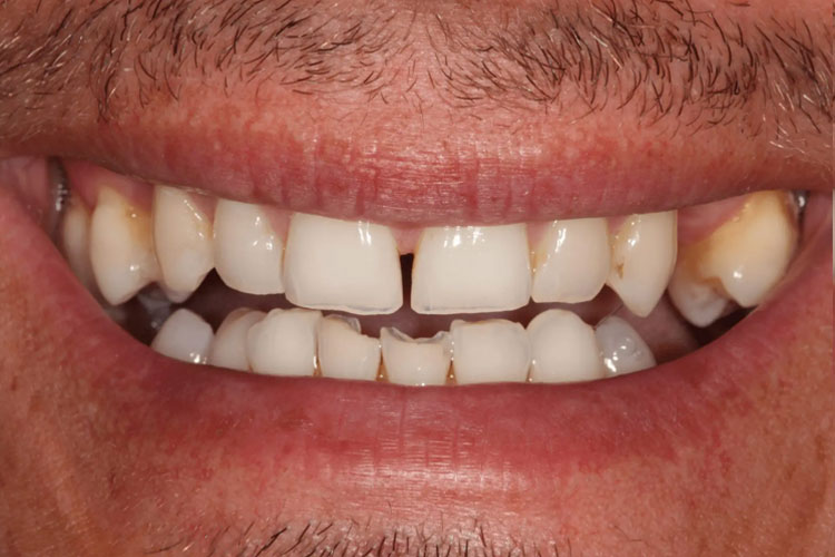 manchester-dental-dental-crowns-before-after--1