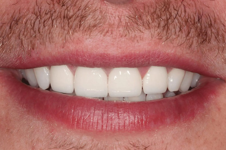 manchester-dental-dental-crowns-before-after--4