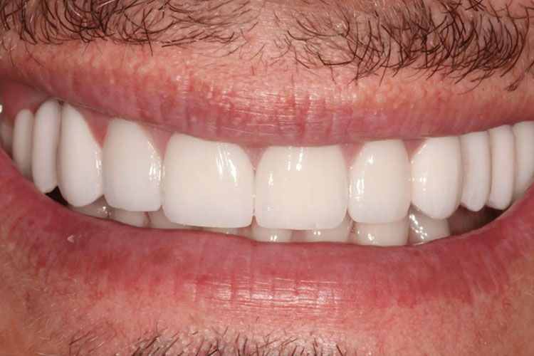 manchester-dental-dental-crowns-before-after--6