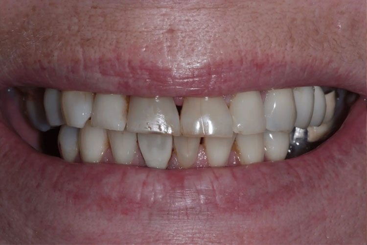 manchester-dental-dental-crowns-before-after--8