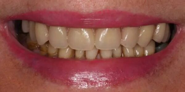 manchester-dental-same-day-implants-after12