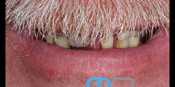 manchester-dental-same-day-implants-before1