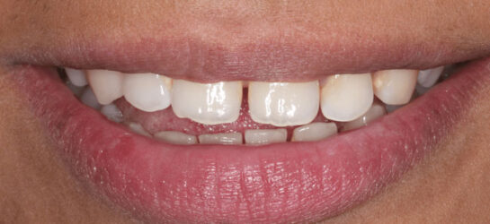 manchester-dental-teeth-whitening--before-after-2
