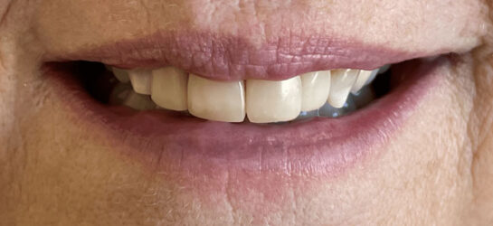 manchester-dental-teeth-whitening--before-after-6