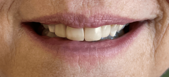 manchesterdental-composite bounding-after3