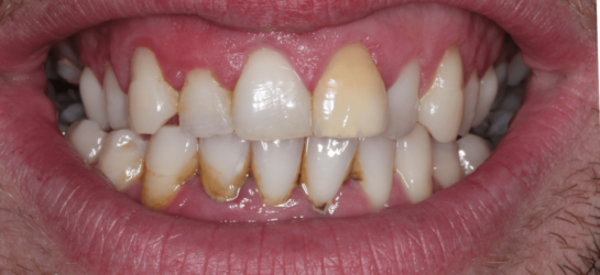 manchesterdental-composite bounding-before1