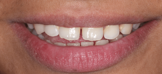 manchesterdental-composite bounding-before12