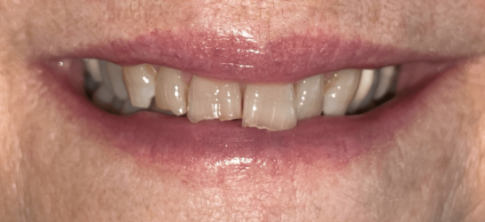 manchesterdental-composite bounding-before13