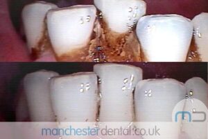 strain removal-manchester dental gallery (1)