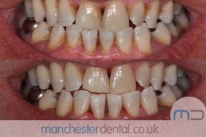 strain removal-manchester dental gallery (2)