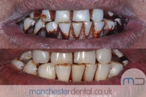 strain removal-manchester dental gallery (3)