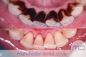 strain removal-manchester dental gallery (4)