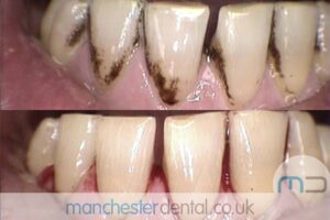 strain removal-manchester dental gallery (6)